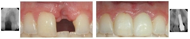 Dental Implants - Anterior