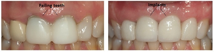 Dental Implants - Anterior